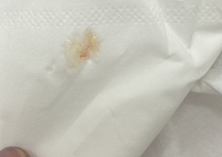 Light spotting at 9DPO after four months TTC, could it be implantation?