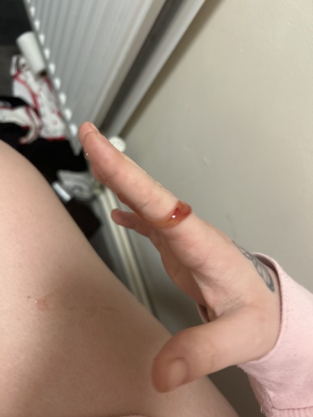 7dpo spotting and migraines while trying to conceive, could it be implantation?