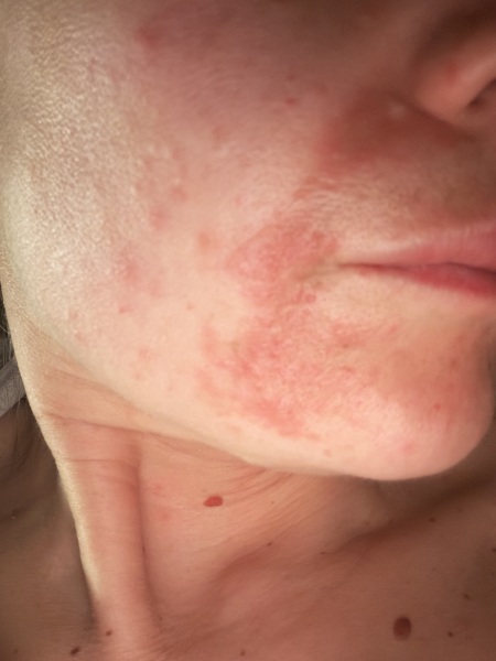 Suspected Perioral Dermatitis Please Help!
