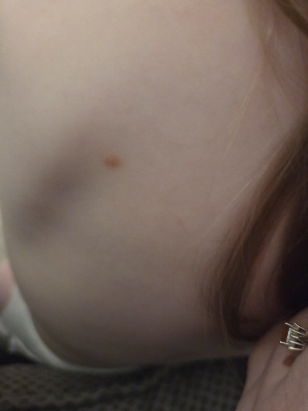 Possible chicken pox