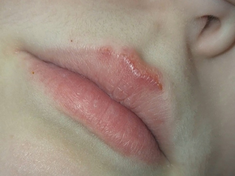 Is this a cold sore? Or something else? Photo in OP
