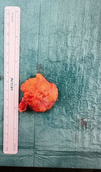 Lipoma removal- would you like to see a photo?