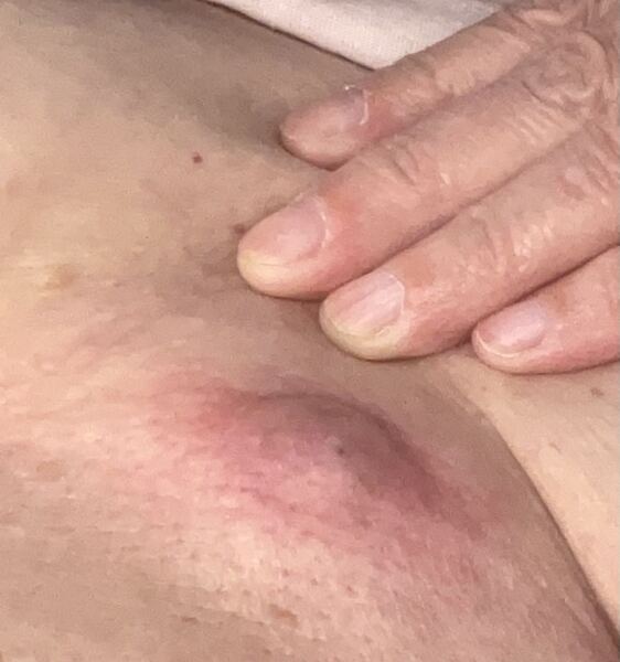 Painful spot getting infected - what to do?