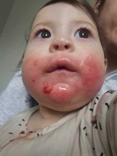 Baby eczema flare up!