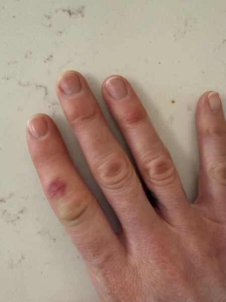 What are these on my fingers?