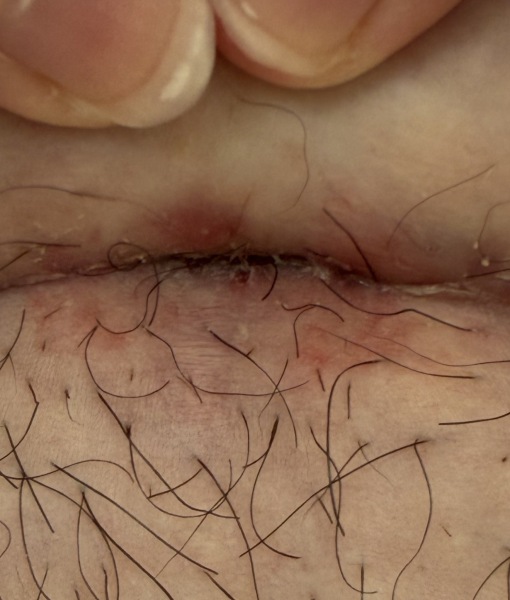 C-section incision opening at four weeks postpartum, how long to close?