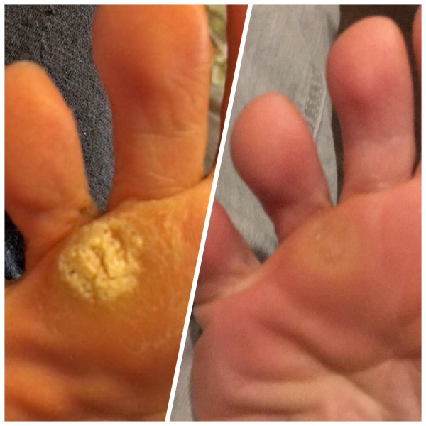 Verucca .. give me tips to rid of it ,  it's deep and horrible.