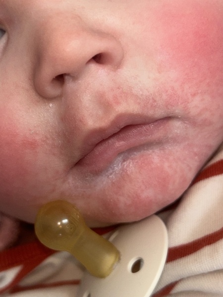 Eczema flares all over body, rash, allergy?