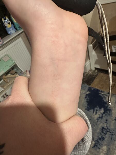 Strange mark appeared on ds wrist