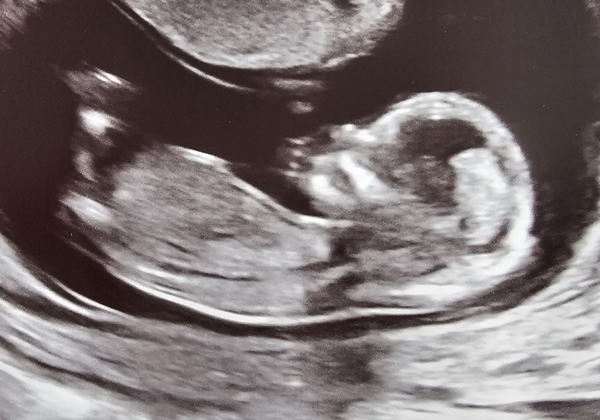Boy or Girl guesses at 13 weeks 4 days scan?