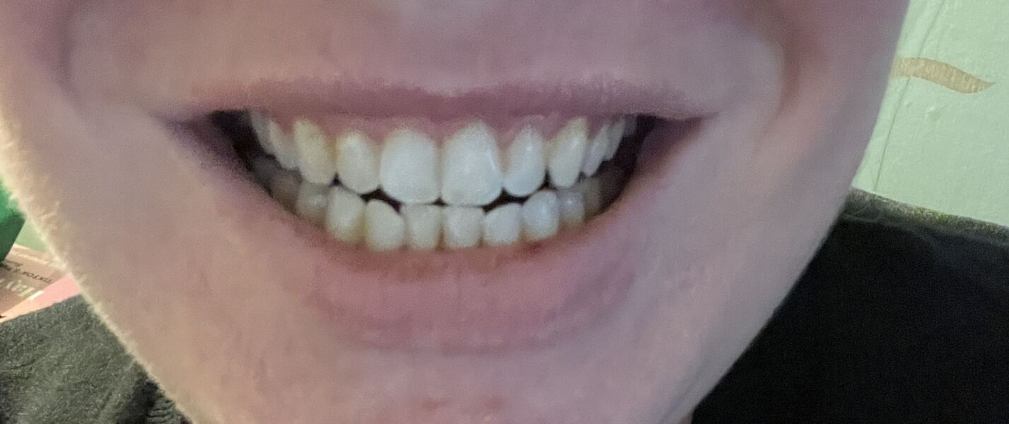 What colour are your teeth?