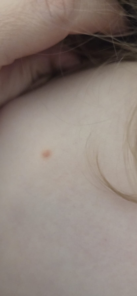 Confused if it's chicken pox