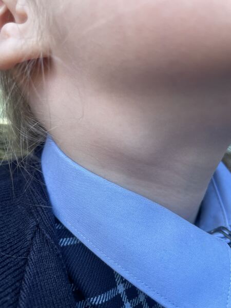 Can anyone see their child's lymph nodes in neck?