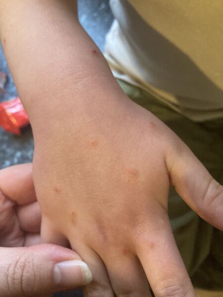 Spots on child
