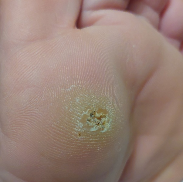 Verucca .. give me tips to rid of it ,  it's deep and horrible.