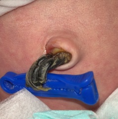 Does this umbilical cord look infected? **TW: photos attached**