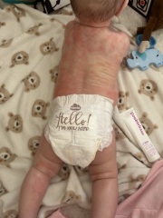 Eczema flares all over body, rash, allergy?