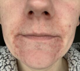 Suspected Perioral Dermatitis Please Help!