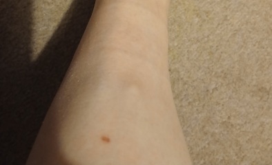 Two long-standing skin lumps on ankle and shin: any ideas?