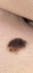 2 week cancer referral for 12 year old...mole