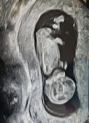 Recurrent Chemical Pregnancies