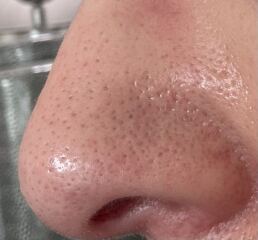 Anyone tried skin peels at home? Need something for the revolting blackheads or SFs on my nose.