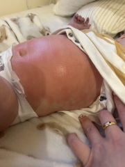 Eczema flares all over body, rash, allergy?
