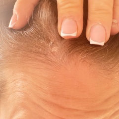 Dry flakey scalp