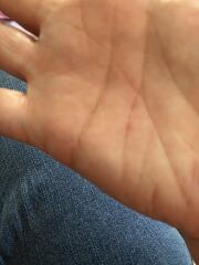 Scabies (again!) How long to get believed that you still have it following treatment?!