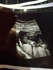 Potty shot 17 weeks 1 day