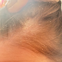 Dry flakey scalp