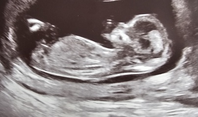 Boy or Girl guesses at 13 weeks 4 days scan?