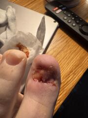 Still not infected-help?