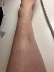 Does anyone know what these marks are on my leg please?