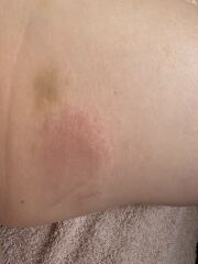 I am being colonised by a fungal infection
