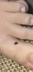 2 week cancer referral for 12 year old...mole