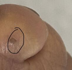 Mole on feet any advice please ?