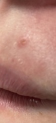 AIBU to worry a persistent spot under my nose could be BCC?