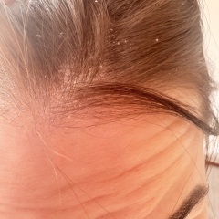 Dry flakey scalp