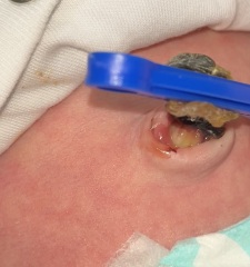 Does this umbilical cord look infected? **TW: photos attached**