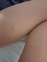 To ask if these are bed bug bites