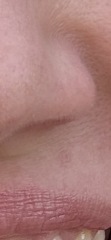 AIBU to worry a persistent spot under my nose could be BCC?