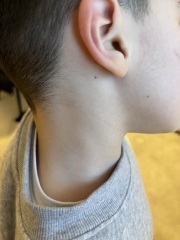 Anyone else have experience with visible lymph node in child?