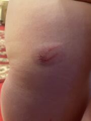 Dog bite or scratch?