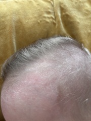 Baby has extremely dry scalp , what to use ?