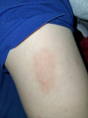 Persistent unexplained mark on child’s leg after chicken pox treatment