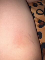 I am being colonised by a fungal infection