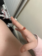 Implantation bleeding ?