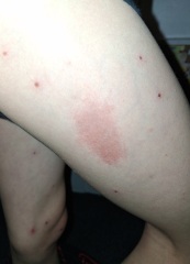 Persistent unexplained mark on child’s leg after chicken pox treatment