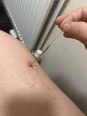 7dpo spotting and migraines while trying to conceive, could it be implantation?